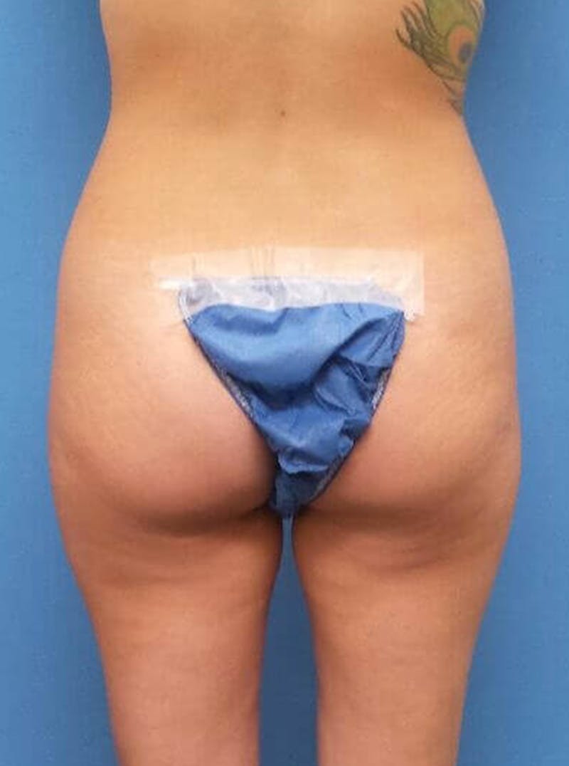 Liposuction Before & After Gallery - Patient 679370 - Image 5
