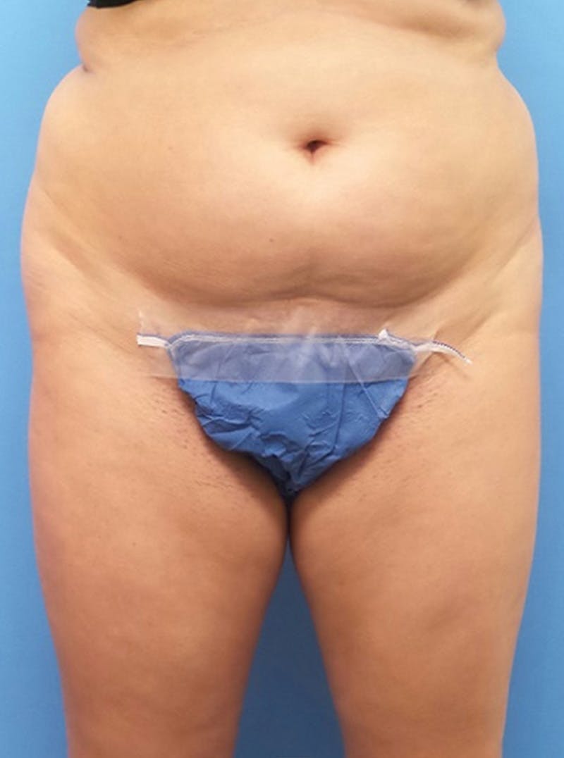 Liposuction Before & After Gallery - Patient 394906 - Image 1