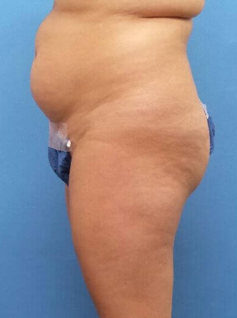 Liposuction Before & After Gallery - Patient 394906 - Image 3