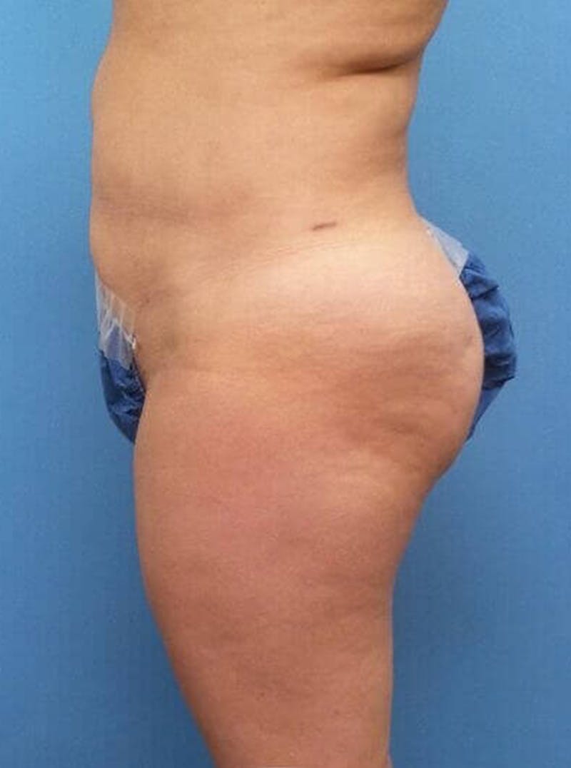 Liposuction Before & After Gallery - Patient 394906 - Image 4