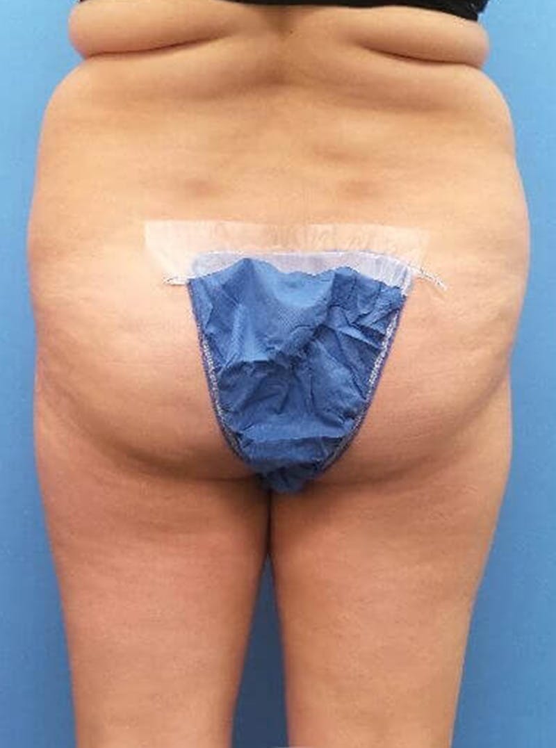 Liposuction Before & After Gallery - Patient 394906 - Image 5
