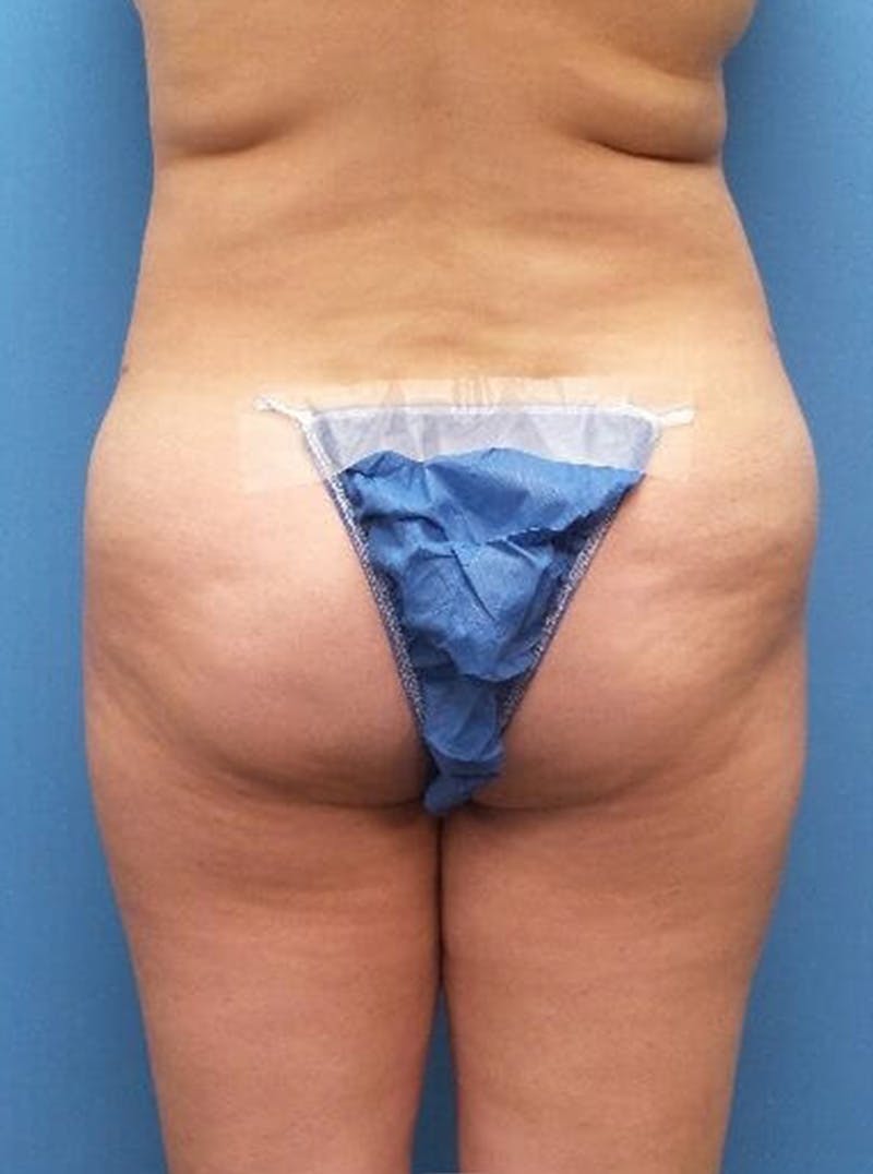 Liposuction Before & After Gallery - Patient 394906 - Image 6
