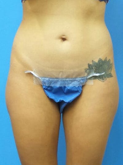 Liposuction Before & After Gallery - Patient 317664 - Image 1