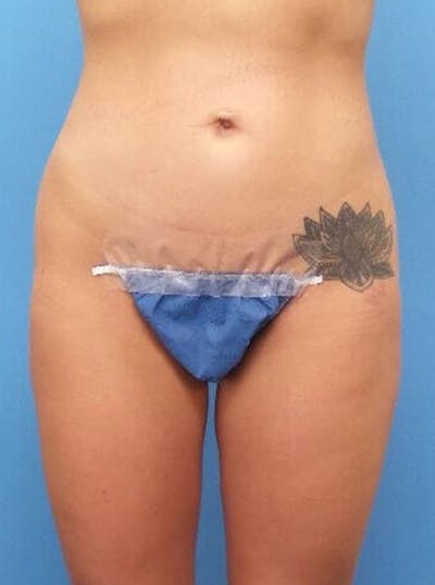 Liposuction Before & After Gallery - Patient 317664 - Image 2