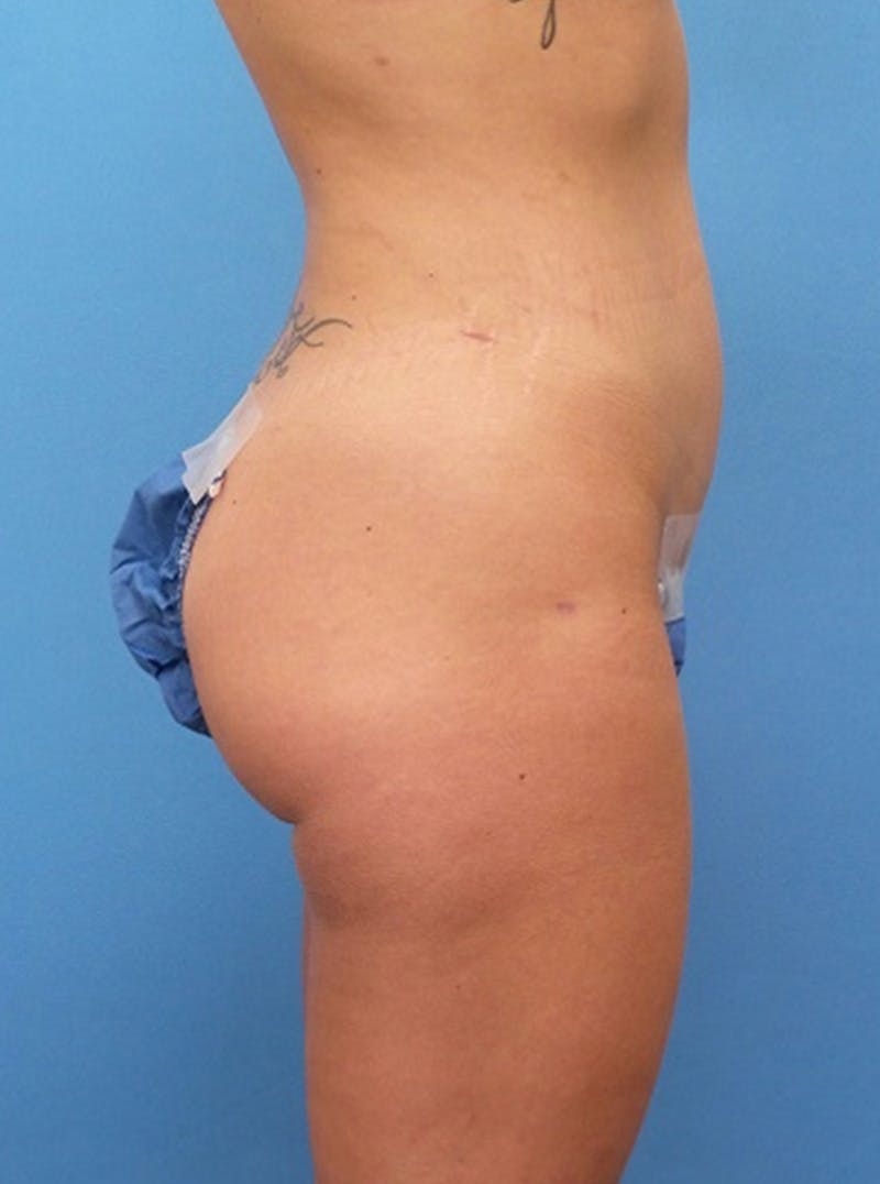 Liposuction Before & After Gallery - Patient 317664 - Image 4