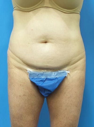 Liposuction Before & After Gallery - Patient 865133 - Image 1