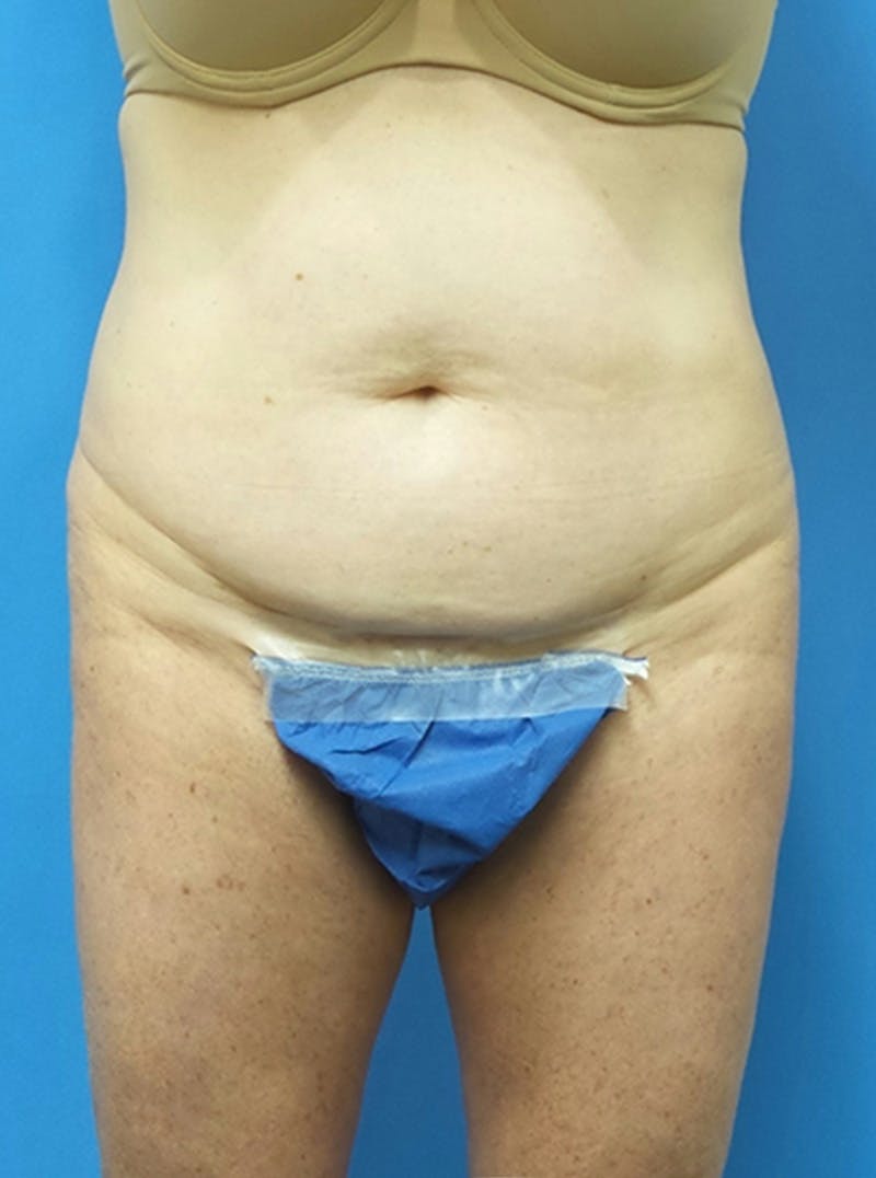 Liposuction Before & After Gallery - Patient 865133 - Image 1