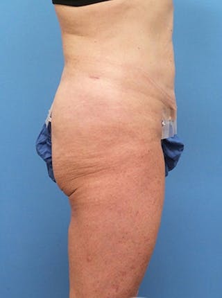 Liposuction Before & After Gallery - Patient 865133 - Image 4