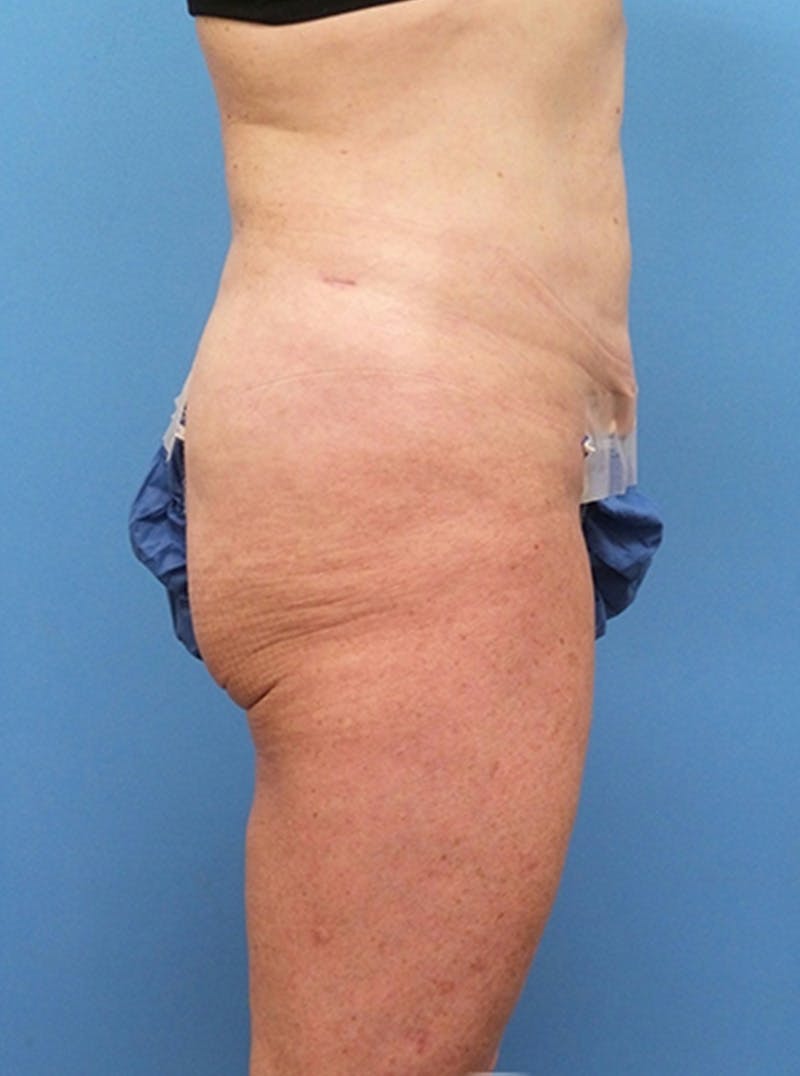 Liposuction Before & After Gallery - Patient 865133 - Image 4
