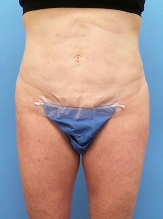 Liposuction Before & After Gallery - Patient 865133 - Image 2
