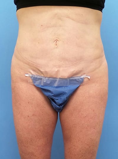 Liposuction Before & After Gallery - Patient 865133 - Image 2