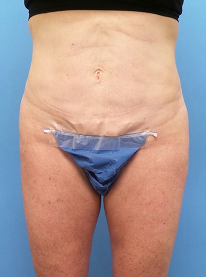Liposuction Before & After Gallery - Patient 865133 - Image 2