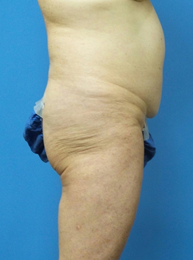 Liposuction Before & After Gallery - Patient 865133 - Image 3
