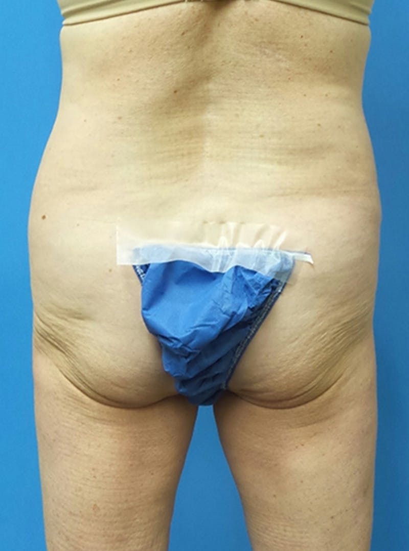 Liposuction Before & After Gallery - Patient 865133 - Image 5