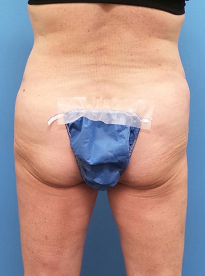 Liposuction Before & After Gallery - Patient 865133 - Image 6