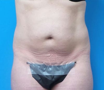Abdominoplasty Before & After Gallery - Patient 321222 - Image 1
