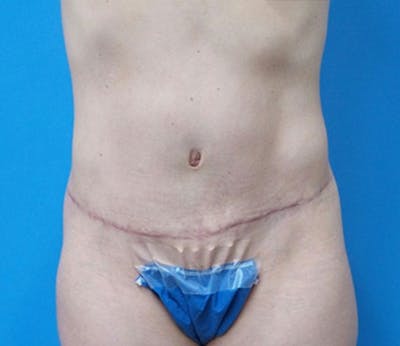 Abdominoplasty Before & After Gallery - Patient 321222 - Image 2
