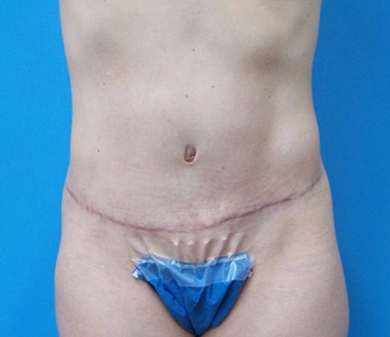 Abdominoplasty Before & After Gallery - Patient 321222 - Image 2