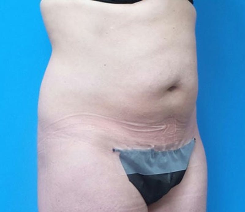 Abdominoplasty Before & After Gallery - Patient 321222 - Image 3