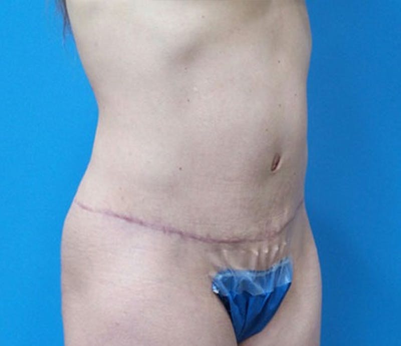 Abdominoplasty Before & After Gallery - Patient 321222 - Image 4