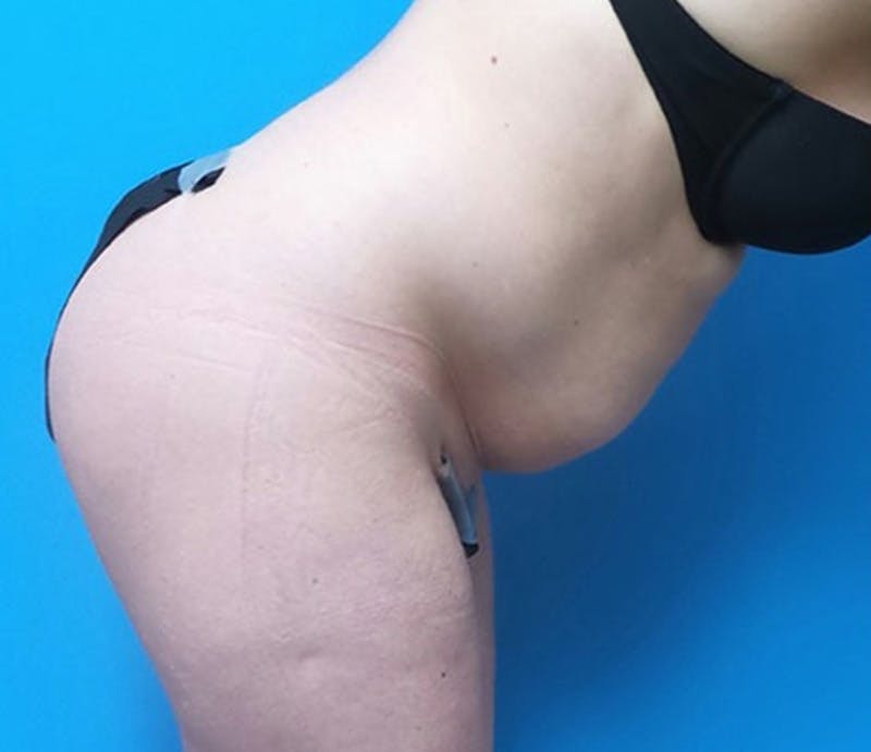 Abdominoplasty Before & After Gallery - Patient 321222 - Image 5
