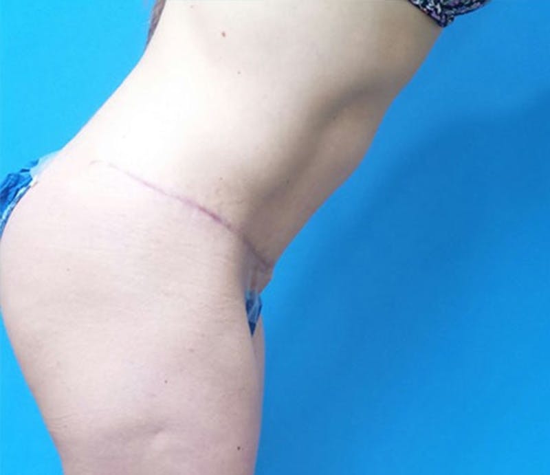 Abdominoplasty Before & After Gallery - Patient 321222 - Image 6