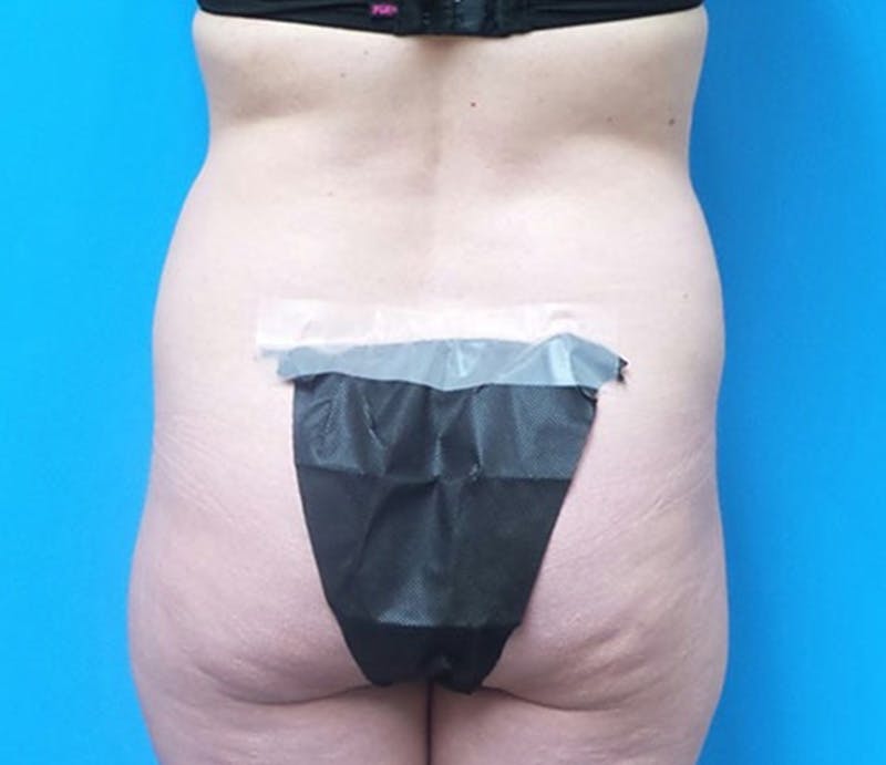Abdominoplasty Before & After Gallery - Patient 321222 - Image 7