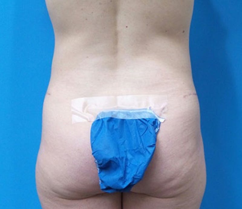 Abdominoplasty Before & After Gallery - Patient 321222 - Image 8