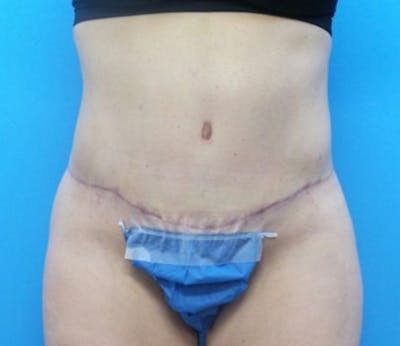 Abdominoplasty Before & After Gallery - Patient 359669 - Image 2