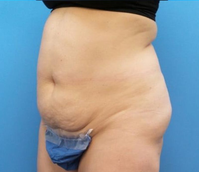 Abdominoplasty Before & After Gallery - Patient 359669 - Image 3