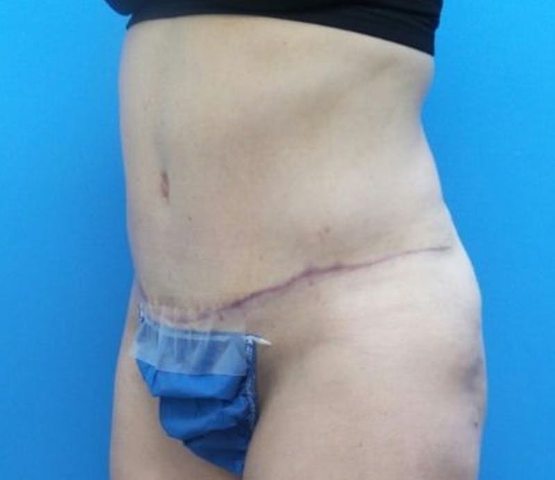 Abdominoplasty Before & After Gallery - Patient 359669 - Image 4