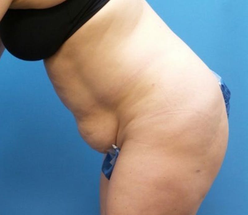 Abdominoplasty Before & After Gallery - Patient 359669 - Image 5