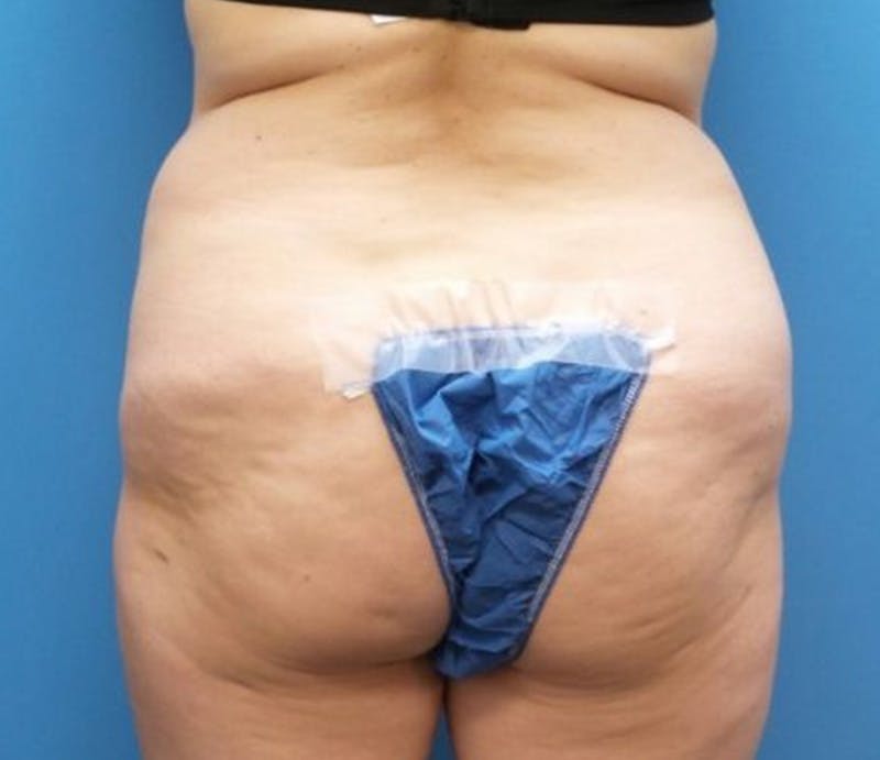 Abdominoplasty Before & After Gallery - Patient 359669 - Image 7