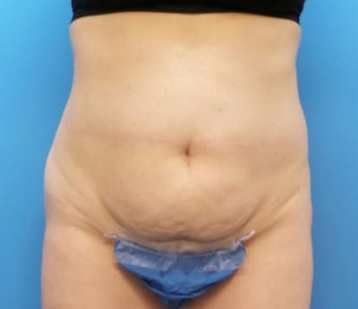 Abdominoplasty Before & After Gallery - Patient 359669 - Image 1