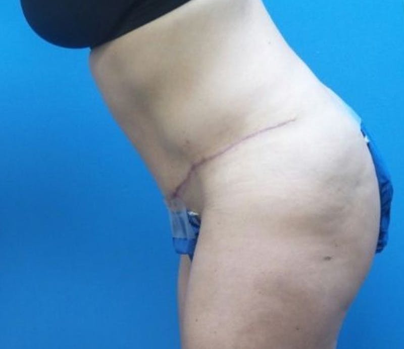 Abdominoplasty Before & After Gallery - Patient 359669 - Image 6