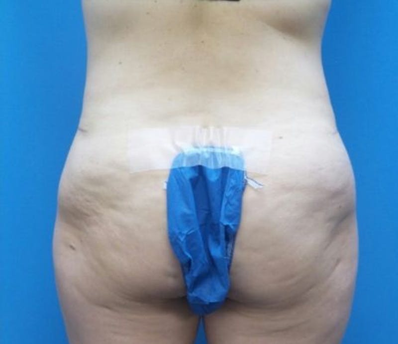 Abdominoplasty Before & After Gallery - Patient 359669 - Image 8