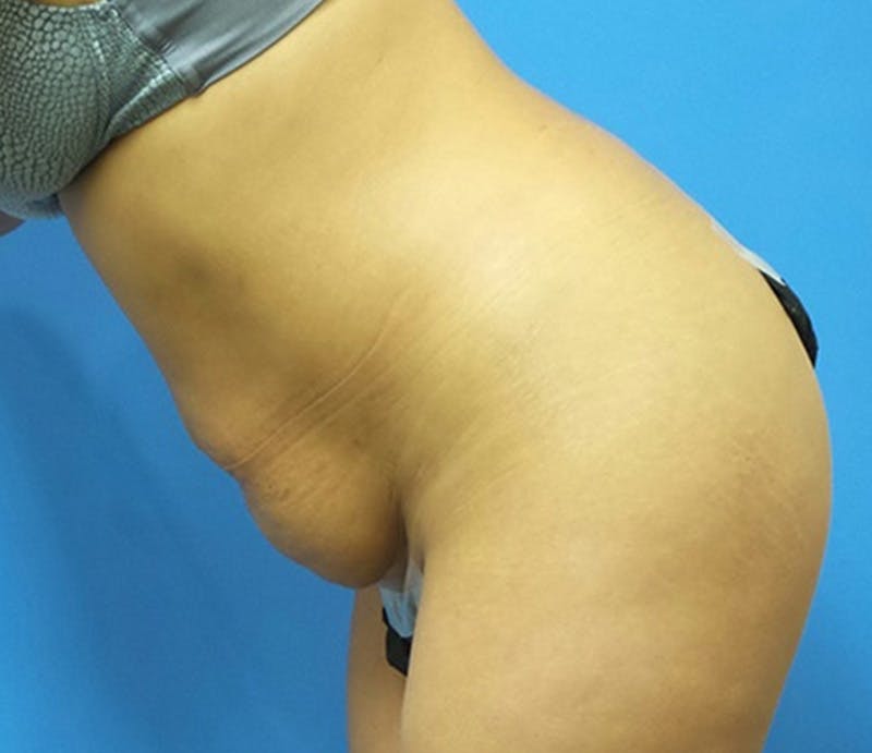 Abdominoplasty Before & After Gallery - Patient 413380 - Image 5
