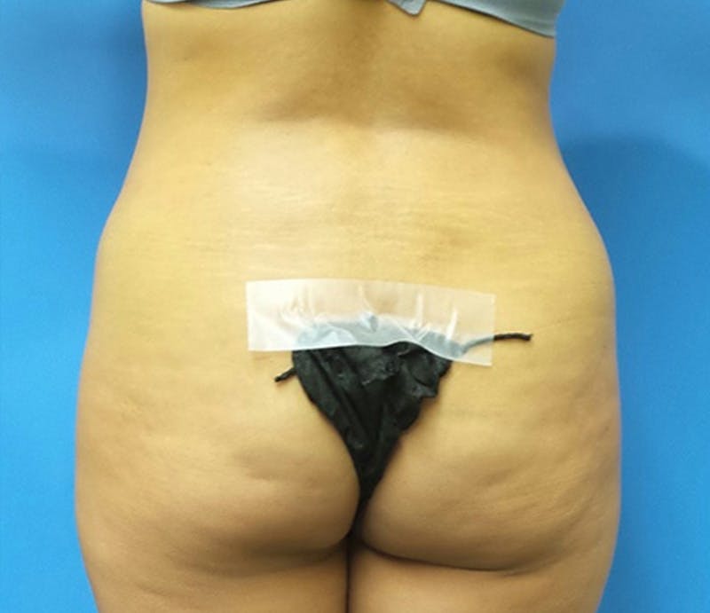 Abdominoplasty Before & After Gallery - Patient 413380 - Image 7