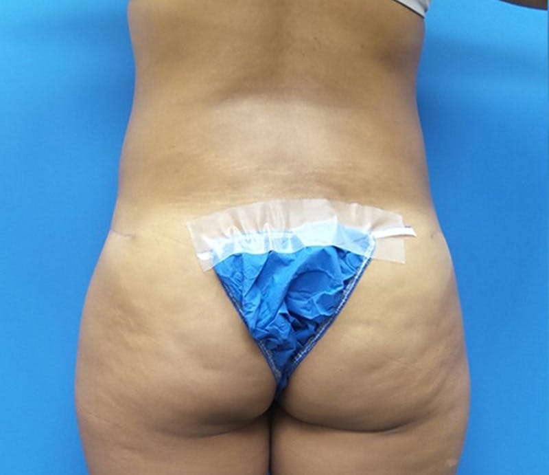 Abdominoplasty Before & After Gallery - Patient 413380 - Image 8