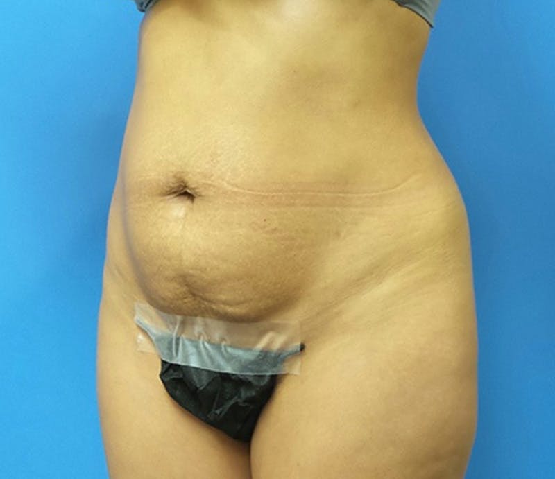 Abdominoplasty Before & After Gallery - Patient 413380 - Image 3