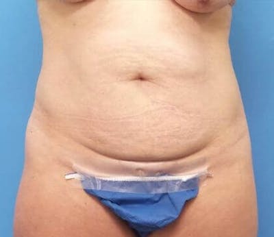 Abdominoplasty Before & After Gallery - Patient 476691 - Image 1