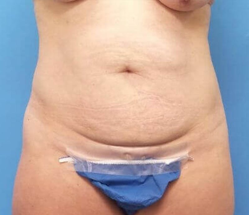Abdominoplasty Before & After Gallery - Patient 476691 - Image 1