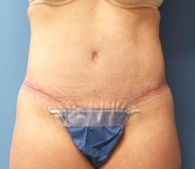 Abdominoplasty Before & After Gallery - Patient 476691 - Image 2