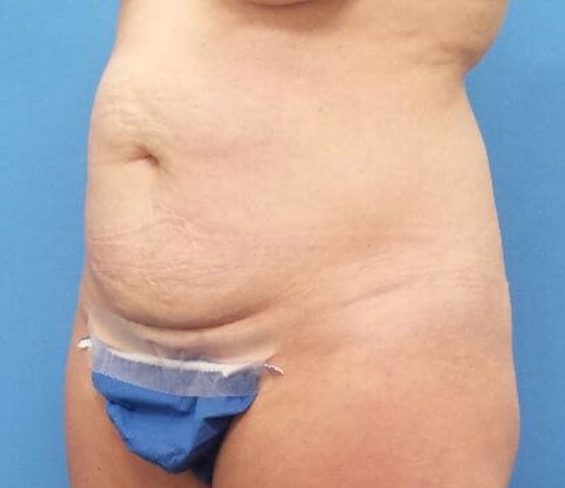 Abdominoplasty Before & After Gallery - Patient 476691 - Image 3
