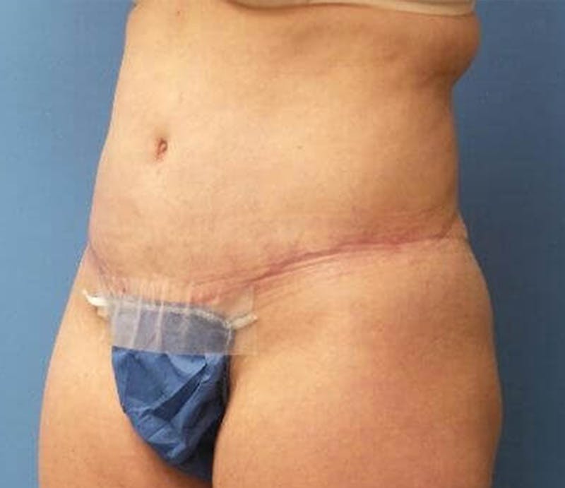 Abdominoplasty Before & After Gallery - Patient 476691 - Image 4