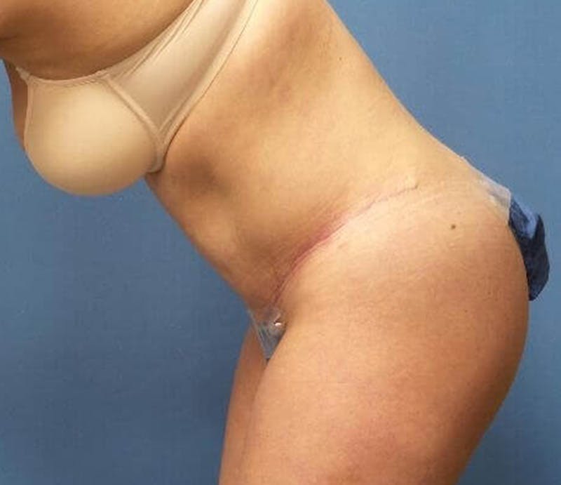 Abdominoplasty Before & After Gallery - Patient 476691 - Image 6