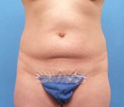 Abdominoplasty Before & After Gallery - Patient 239575 - Image 1