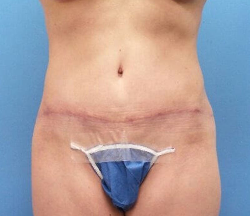 Abdominoplasty Before & After Gallery - Patient 239575 - Image 2