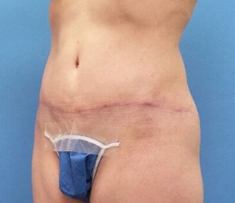 Abdominoplasty Before & After Gallery - Patient 239575 - Image 4
