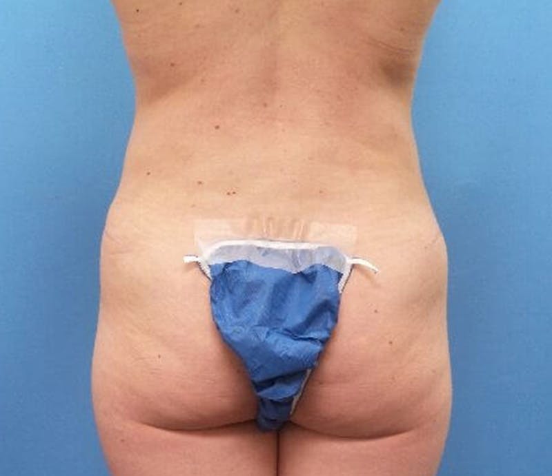 Abdominoplasty Before & After Gallery - Patient 239575 - Image 8